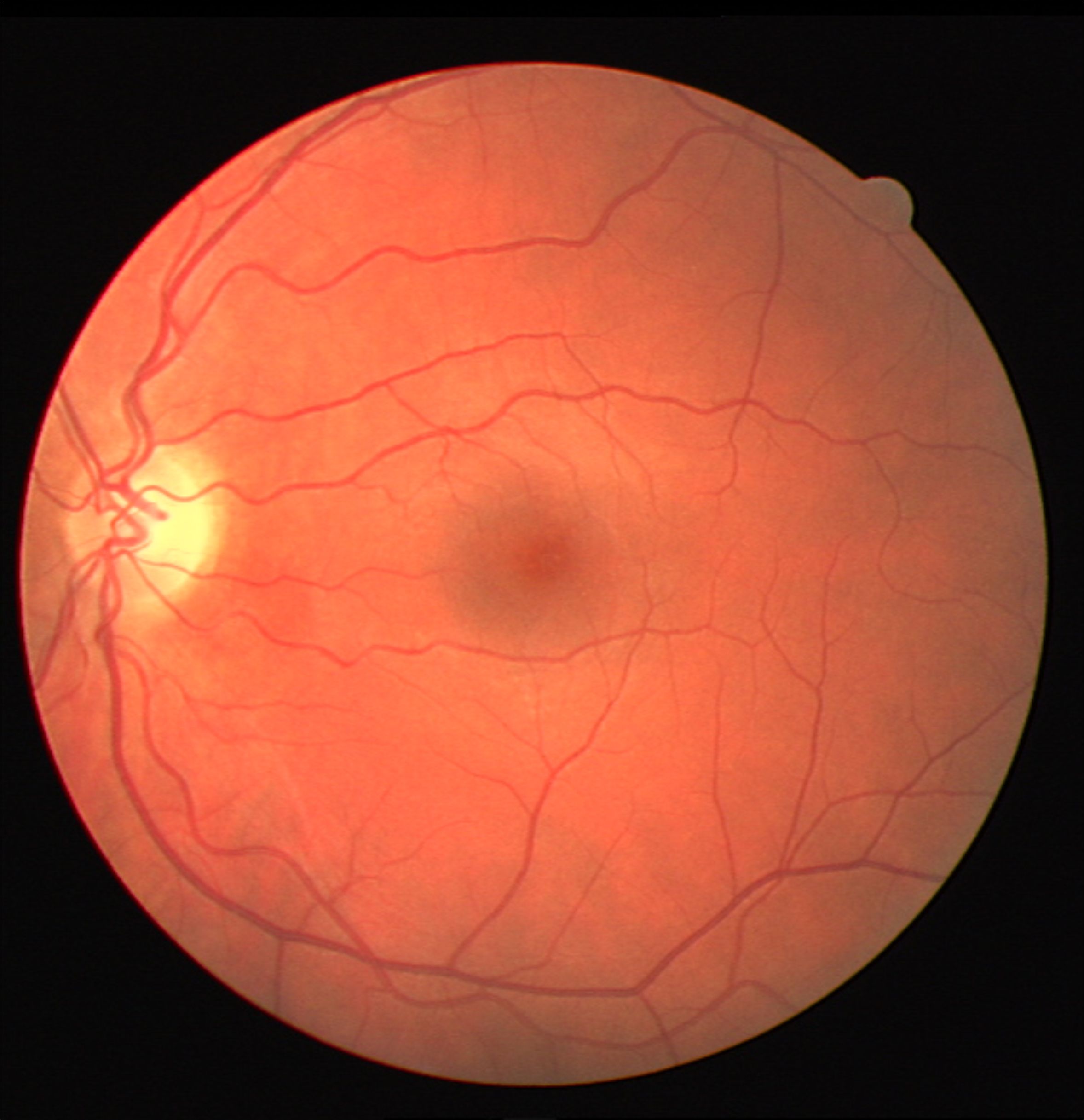 fundus