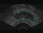 Detected Prostate